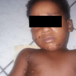 The 1-Y-O who was burnt with acid along with his mother in Suriname